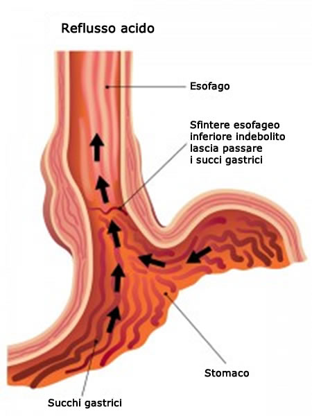 Il protettore dello stomaco esofagite  007 